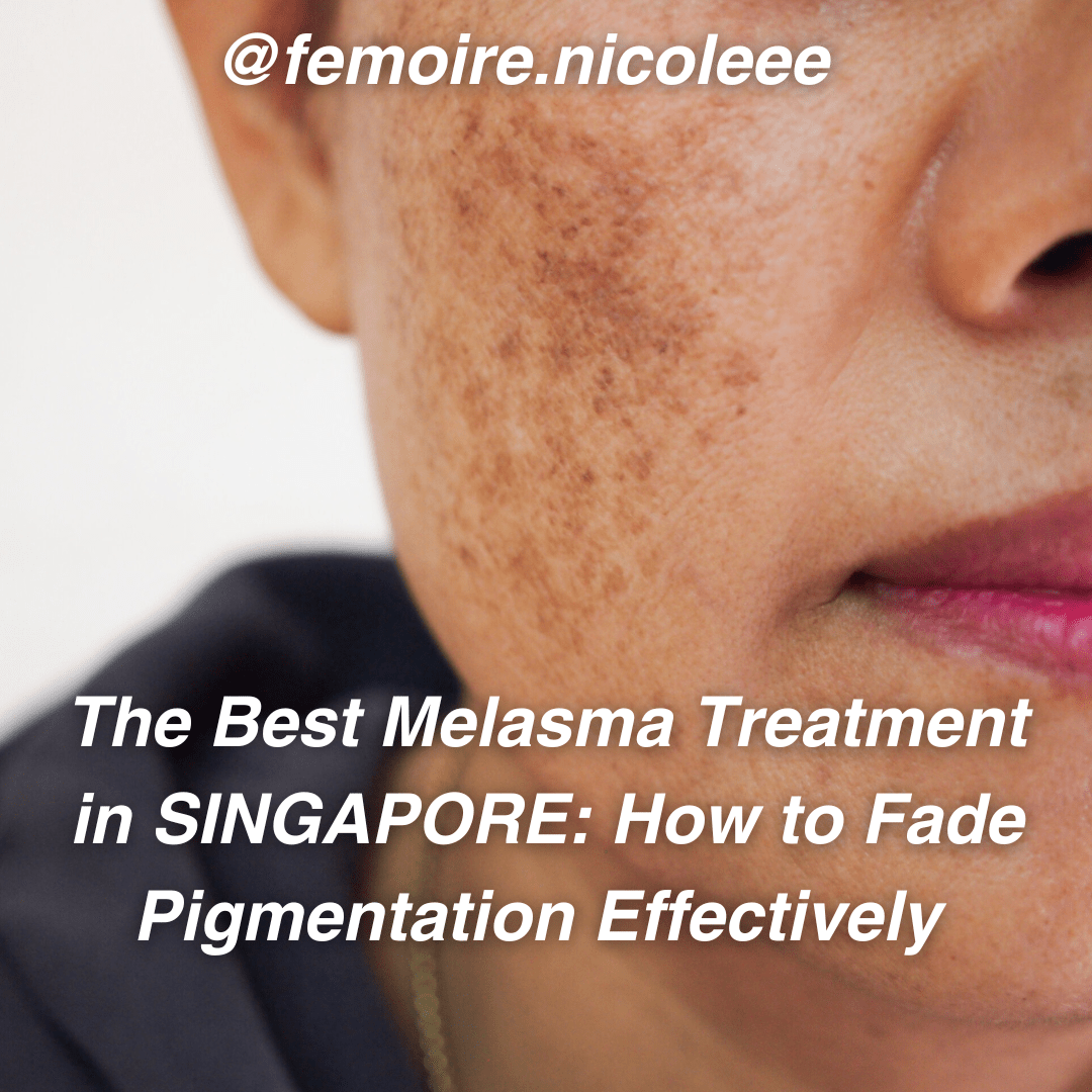 The Best Melasma Treatment in Singapore: How to Fade Pigmentation Effectively