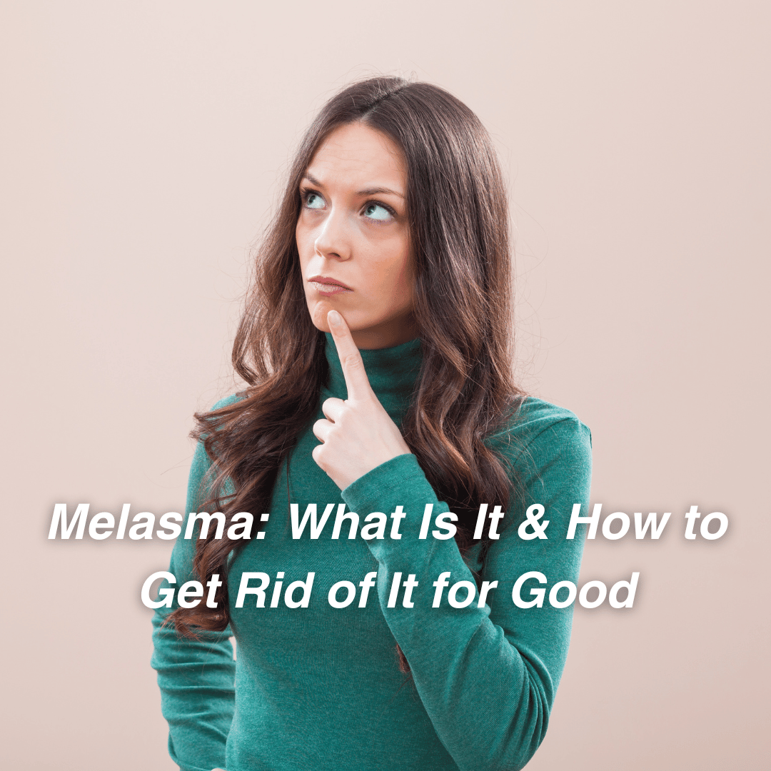 Melasma: What Is It & How to Get Rid of It for Good